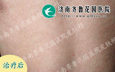 背部荨麻疹怎么治,郭先生经过一段时间治疗后,背部荨麻疹已经从根本上消除了,既达到治标又达到了治本的疗效。