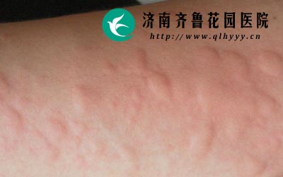 急性荨麻疹发病比较急消退的也比较快