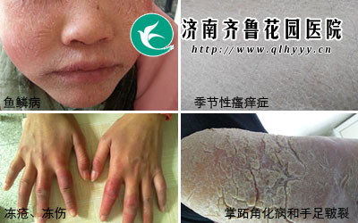 冬季易发的皮肤病及预防措施