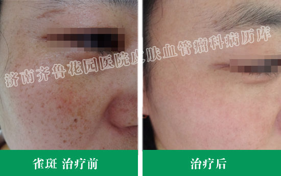 我院雀斑患者曾采用多联阶梯技术综合治疗成功后的治疗前后对比照片