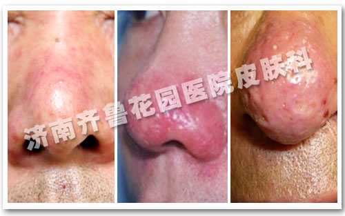 酒渣鼻可以不治吗