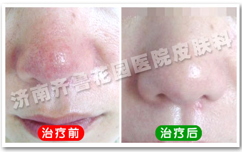 酒渣鼻能治好吗