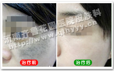 脸上的太田痣经我院治疗后的前后对比照片