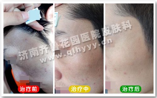 患者脸上的太田痣尤为明显已经对自身容貌产生了很大的影响