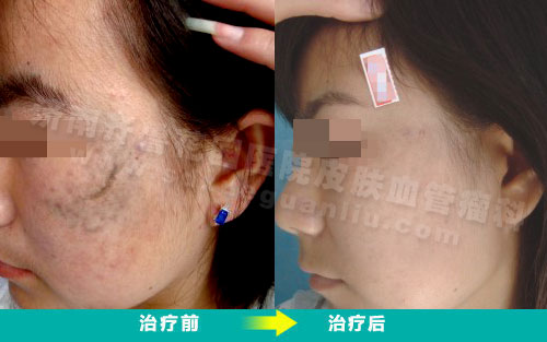 颧部太田痣患者经济南齐鲁花园医院皮肤科治疗前后对比照片