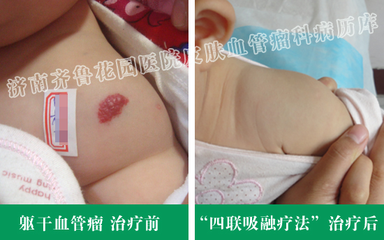 Ѫ�������������������Ʒ�����ǰ��Ա���Ƭ