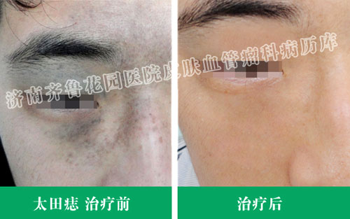 太田痣治疗康复案例