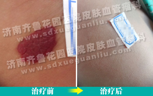 ������౳��Ѫ���������������Ʒ�����ǰ��Ա���Ƭ