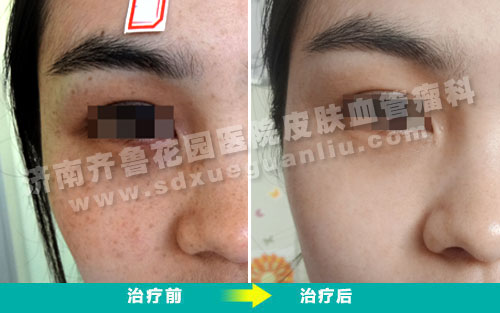 面部雀斑患者经多联阶梯技术治疗前后对比照片