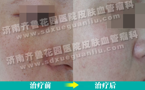 雀斑患者经多联阶梯技术治疗前后对比照片