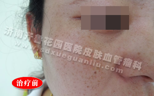 面部雀斑患者治疗前的照片
