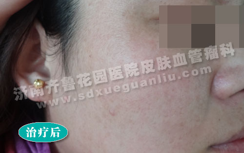 面部雀斑患者经多联阶梯技术治疗后的照片