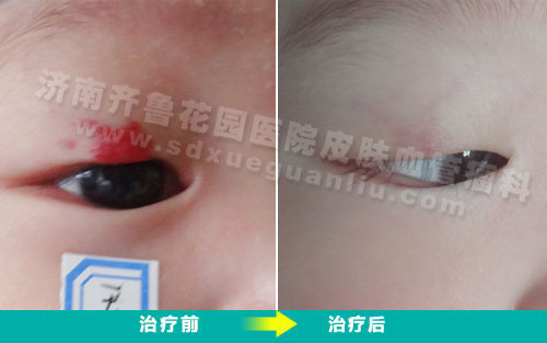 眼部血管瘤患儿经四联吸融疗法治疗前后对比照片