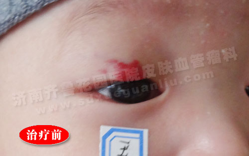 眼部血管瘤患儿治疗前的照片