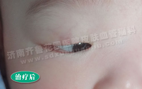 眼部血管瘤患儿经四联吸融疗法治疗后的照片