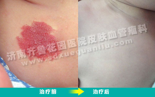 宝宝前胸血管瘤经四联吸融疗法治疗前后对比照片