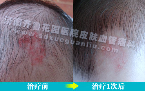 ����ͷ���ϵĺ�ɫ��Ƭ��ô���Ʋ�Ӱ��ͷ������