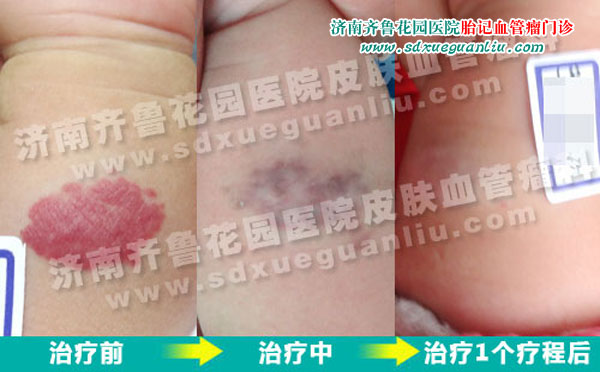 �����첲�ϵ�Ѫ���������������Ʒ�����ǰ��Ա���Ƭ