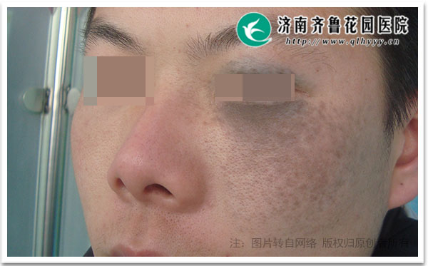 调Q激光太田痣只要孩子满3个月就可以做治疗