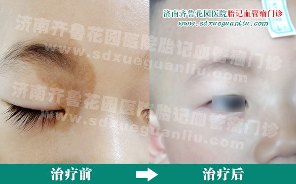 眼部咖啡斑患儿经多联阶梯疗法治疗前后对比照片