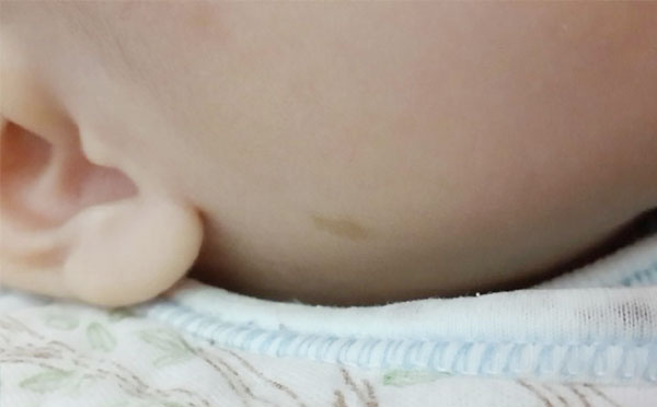 孩子耳朵下有一块咖啡色斑块