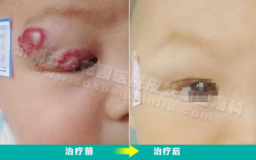 孩子上眼皮上的红斑样草莓状血管瘤经过四联吸融疗法治疗前后对比效果