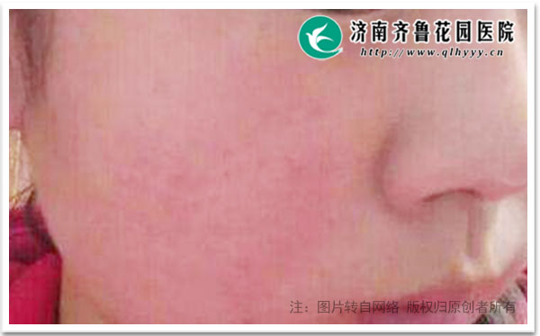 红血丝用什么方法可以去除