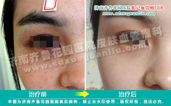 我院治疗雀斑康复案例可见治疗前后的效果是非常好的