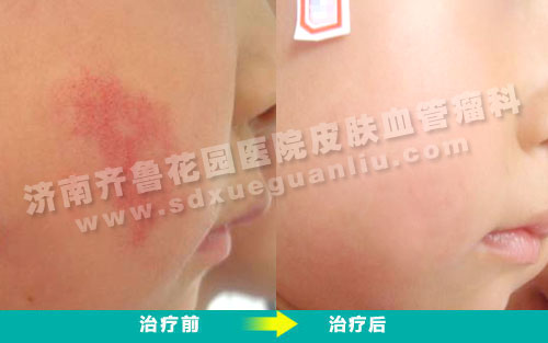 婴幼儿鲜红斑痣经四联吸融疗法治疗前后对比照片