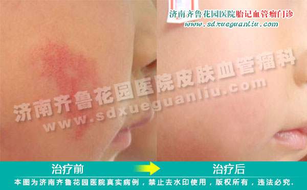 颜面部鲜红斑痣患儿经四联吸融疗法治疗前后对比照片