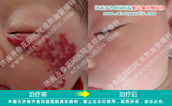 颜面部血管瘤患儿经四联吸融疗法治疗前后对比照片