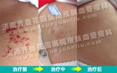 ���Ӷ�Ƥ�ϳ���ߵ������䶳���ַ�������