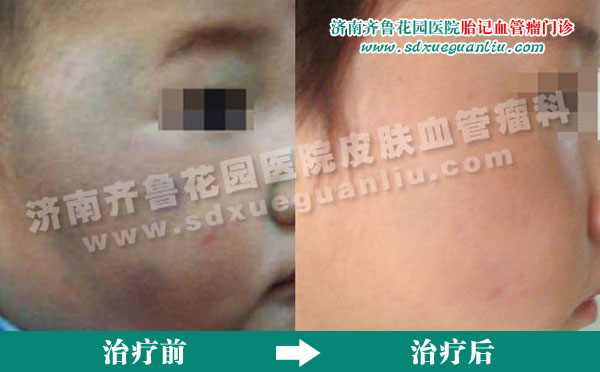 ��ɫ̥�����ٴ����������̫����