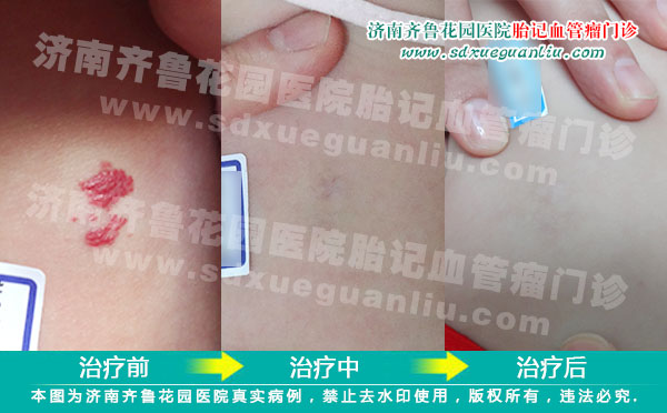 Ѫ��������Ӥ���ڳ���������Ѫ����