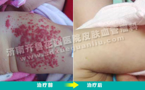 患儿胳膊上的血管瘤经过四联吸融疗法治疗后很快就康复了