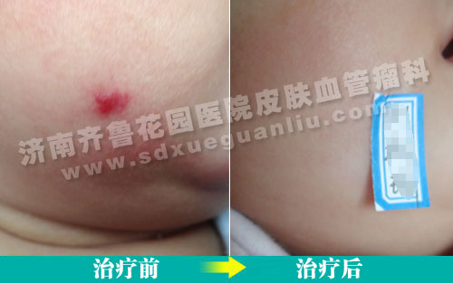 血管瘤患儿经四联吸融疗法治疗前后对比照片