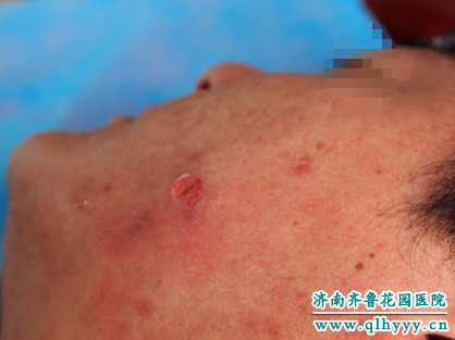 激光治疗皮脂腺瘤后