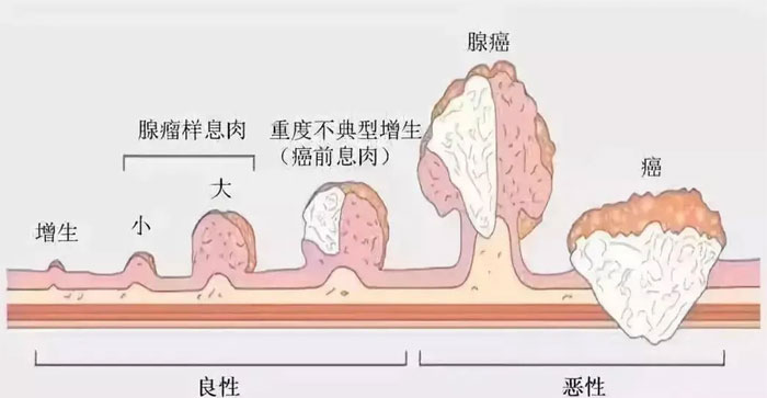 胃癌形成的各个阶段